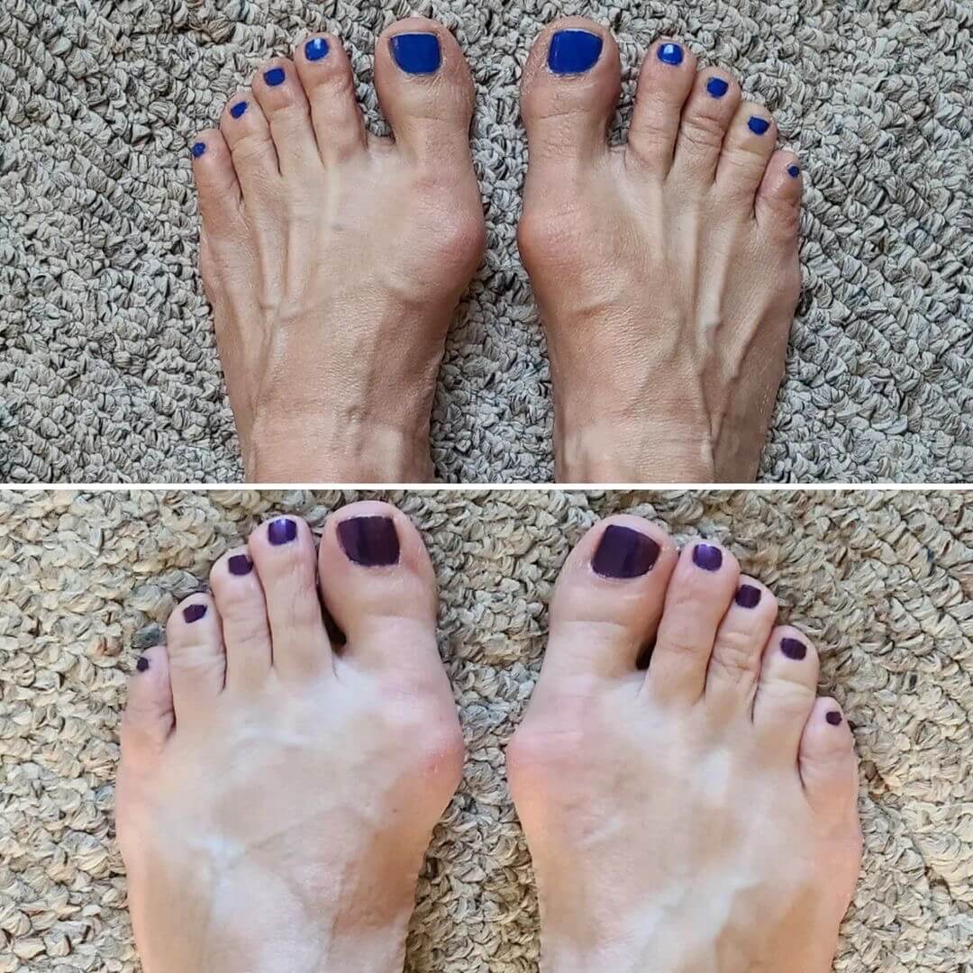 Before and After Correct Toes